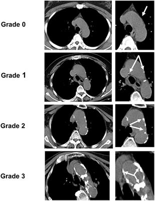 The Relationship Between Aortic Arch Calcification and Recurrent Stroke in Patients With Embolic Stroke of Undetermined Source—A Case-Control Study